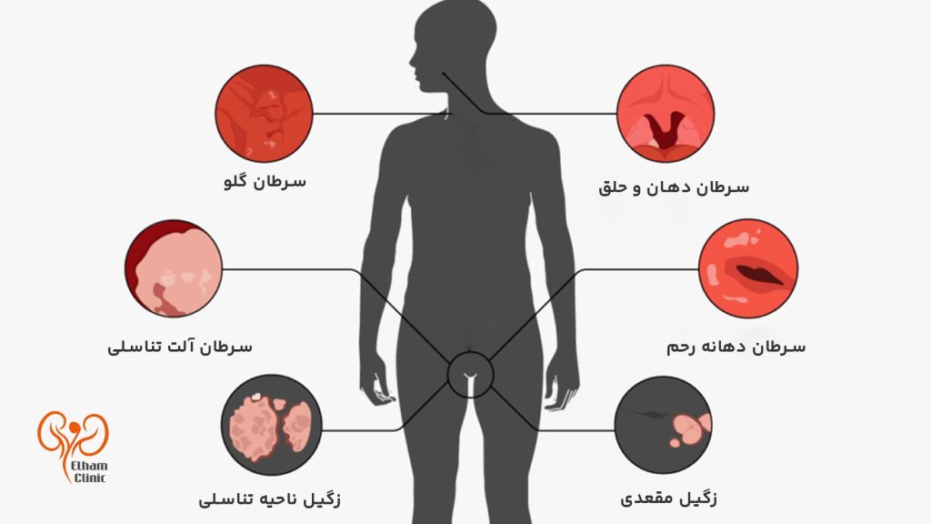درمان اچ پی وی